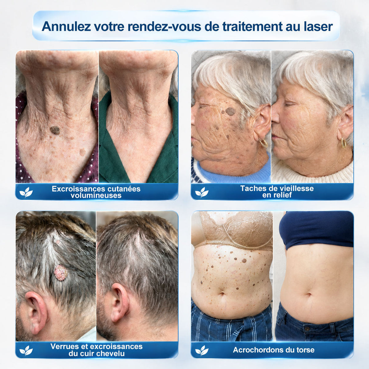 Boutique officielle de la marque 𝐏i𝐜𝐝o® 🍉💖7 Jours Effaceur de taches et d’excroissances cutanées(Zéro douleur, zéro cicatrice – Roller)