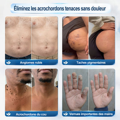 Boutique officielle de la marque 𝐏i𝐜𝐝o® 🍉💖7 Jours Effaceur de taches et d’excroissances cutanées(Zéro douleur, zéro cicatrice – Roller)