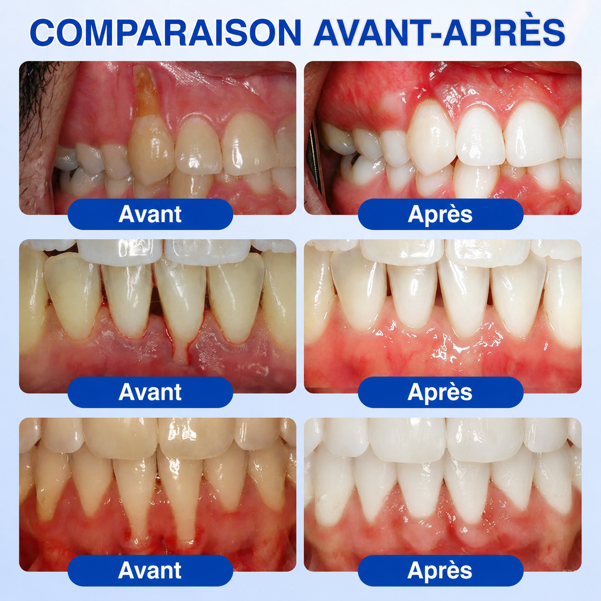 🌼💖 𝑮𝒍𝒊𝒎𝒎𝒆𝒓𝒍𝒚®🦷 𝑮𝒖𝒎𝑹𝒆𝒗𝒊𝒗𝒆 𝑮𝒆𝒍 𝒅𝒆 𝑹é𝒑𝒂𝒓𝒂𝒕𝒊𝒐𝒏 𝑷𝒂𝒓𝒐𝒅𝒐𝒏𝒕𝒂𝒍𝒆