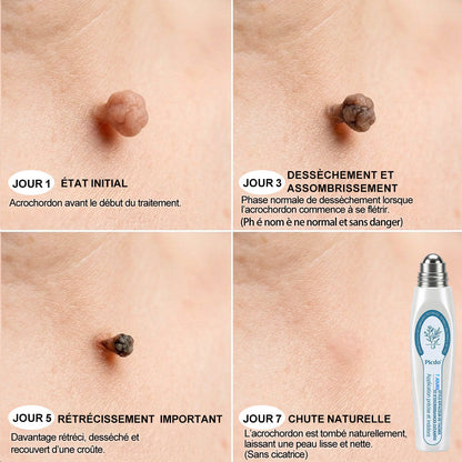 Boutique officielle de la marque 𝐏i𝐜𝐝o® 🍉💖7 Jours Effaceur de taches et d’excroissances cutanées(Zéro douleur, zéro cicatrice – Roller)